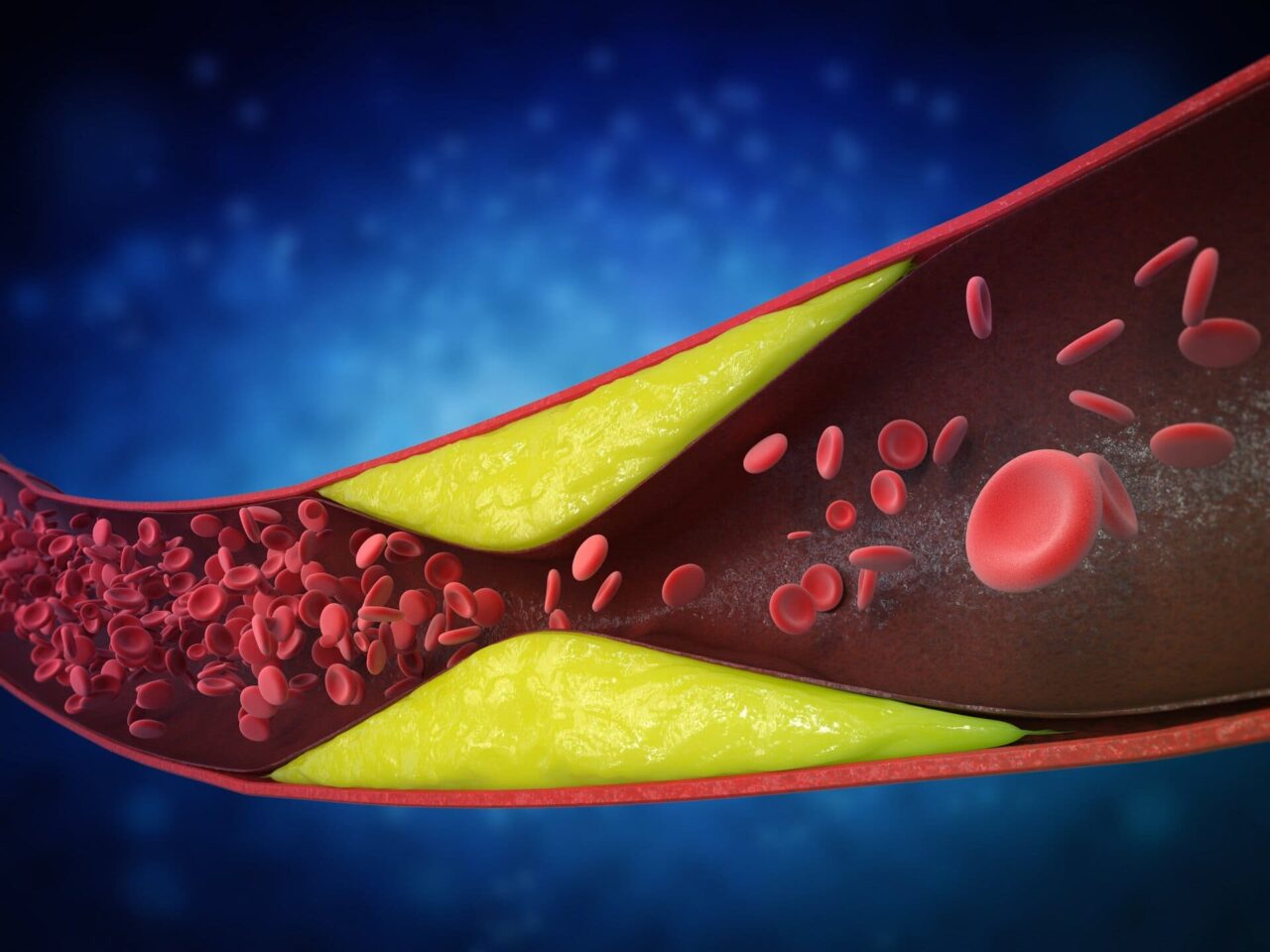 Cholesterol With Diabetes
